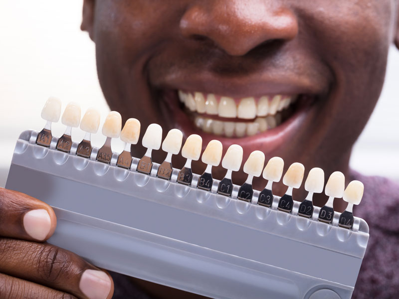 Veneers